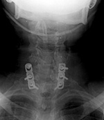 Cervical laminoplasty plates